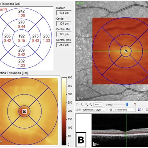 my oct test for thickness was 0.78|does oct affect retinal thickness.